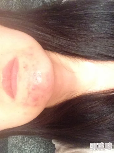 红肿疼痛小缝不能合拢已消肿疼痛减轻但小缝仍未完全闭合