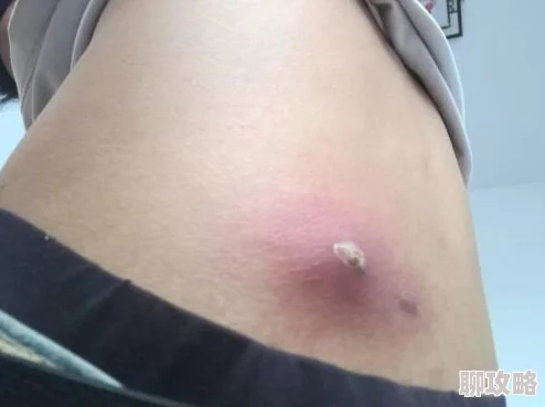 红肿疼痛小缝不能合拢已消肿疼痛减轻但小缝仍未完全闭合