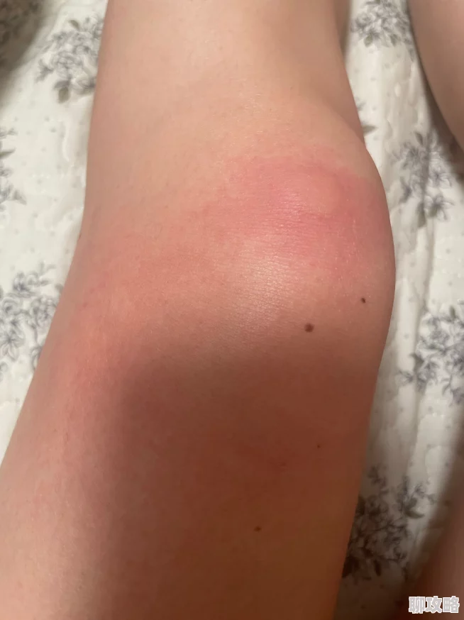 打扑克又痛又痒被蚊子咬了还继续坚持鏖战